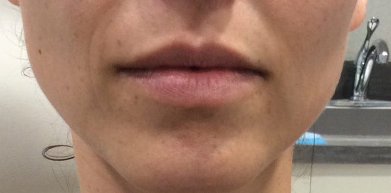 Lip Augmentation Before & After Gallery - Patient 417312 - Image 1