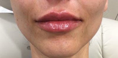 Lip Augmentation Before & After Gallery - Patient 417312 - Image 2