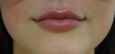 Lip Augmentation Before & After Gallery - Patient 139114 - Image 2