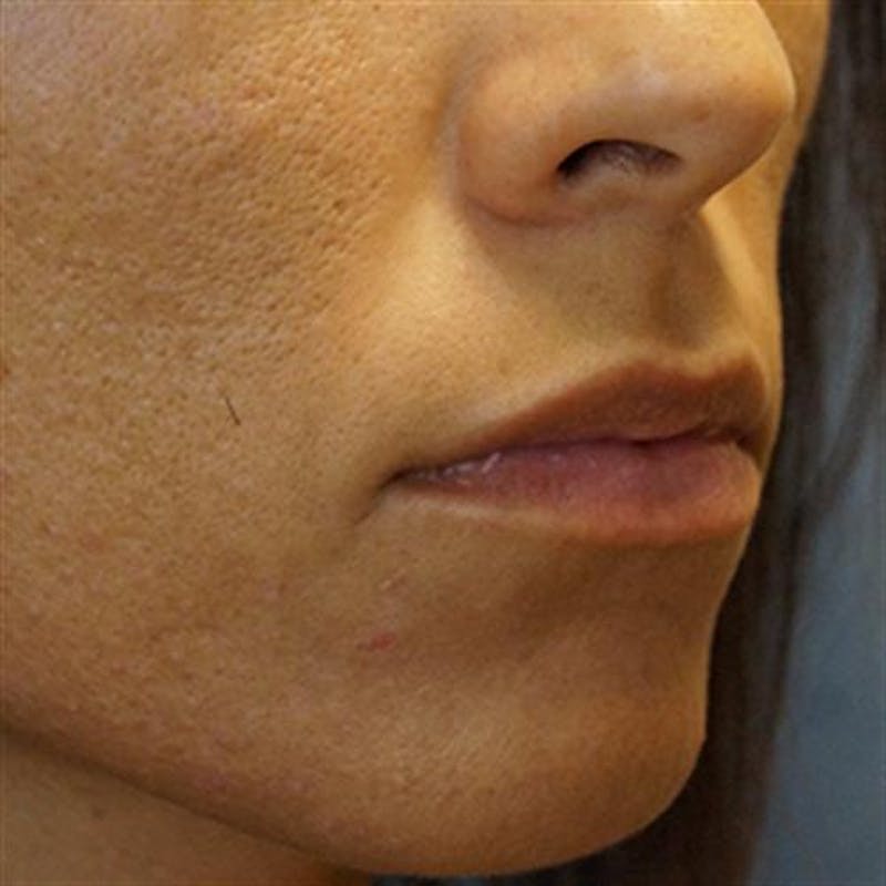 Lip Augmentation Before & After Gallery - Patient 229037 - Image 1