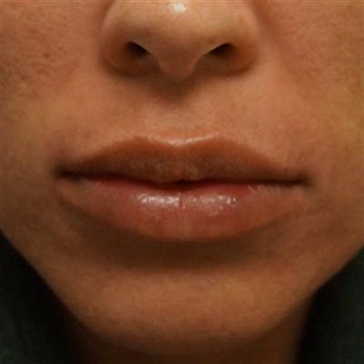 Lip Augmentation Before & After Gallery - Patient 220034 - Image 2