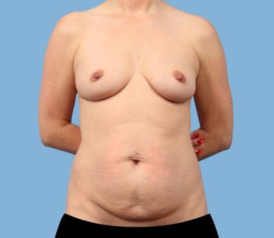 Mommy Makeover Body Contouring Before & After Gallery - Patient 157981 - Image 1