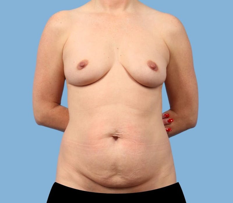 Mommy Makeover Body Contouring Before & After Gallery - Patient 157981 - Image 1