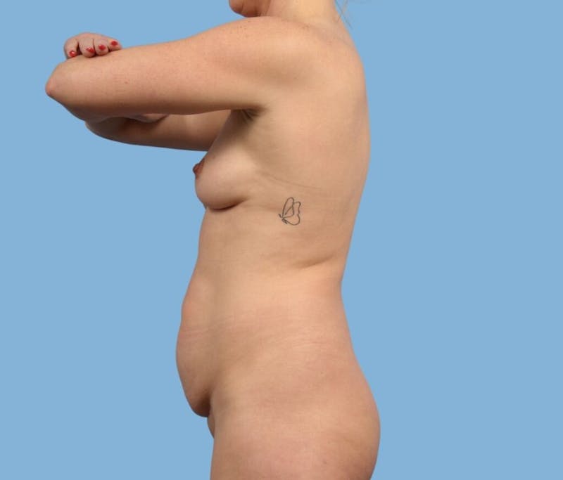 Mommy Makeover Body Contouring Before & After Gallery - Patient 157981 - Image 5