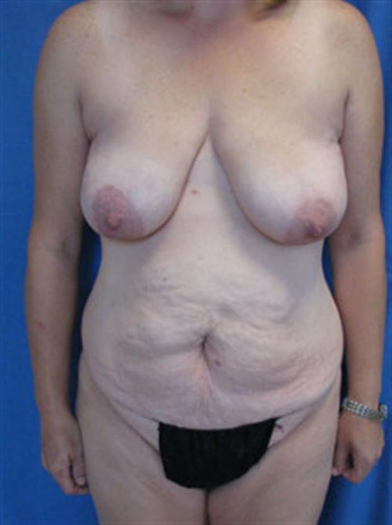Mommy Makeover Body Contouring Before & After Gallery - Patient 215831 - Image 1