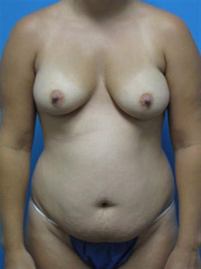 Mommy Makeover Body Contouring Before & After Gallery - Patient 982218 - Image 1