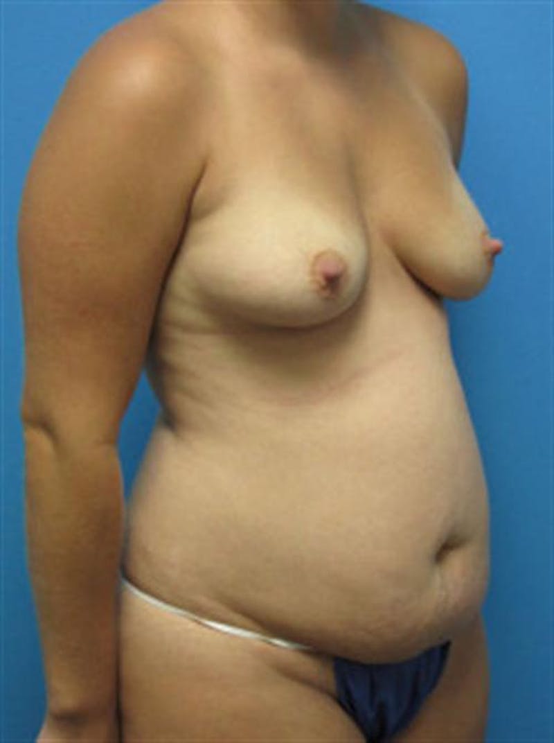 Mommy Makeover Body Contouring Before & After Gallery - Patient 982218 - Image 3