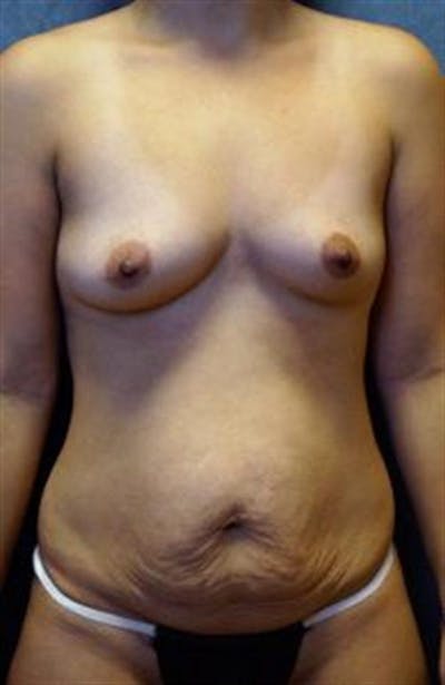 Mommy Makeover Body Contouring Before & After Gallery - Patient 798789 - Image 1