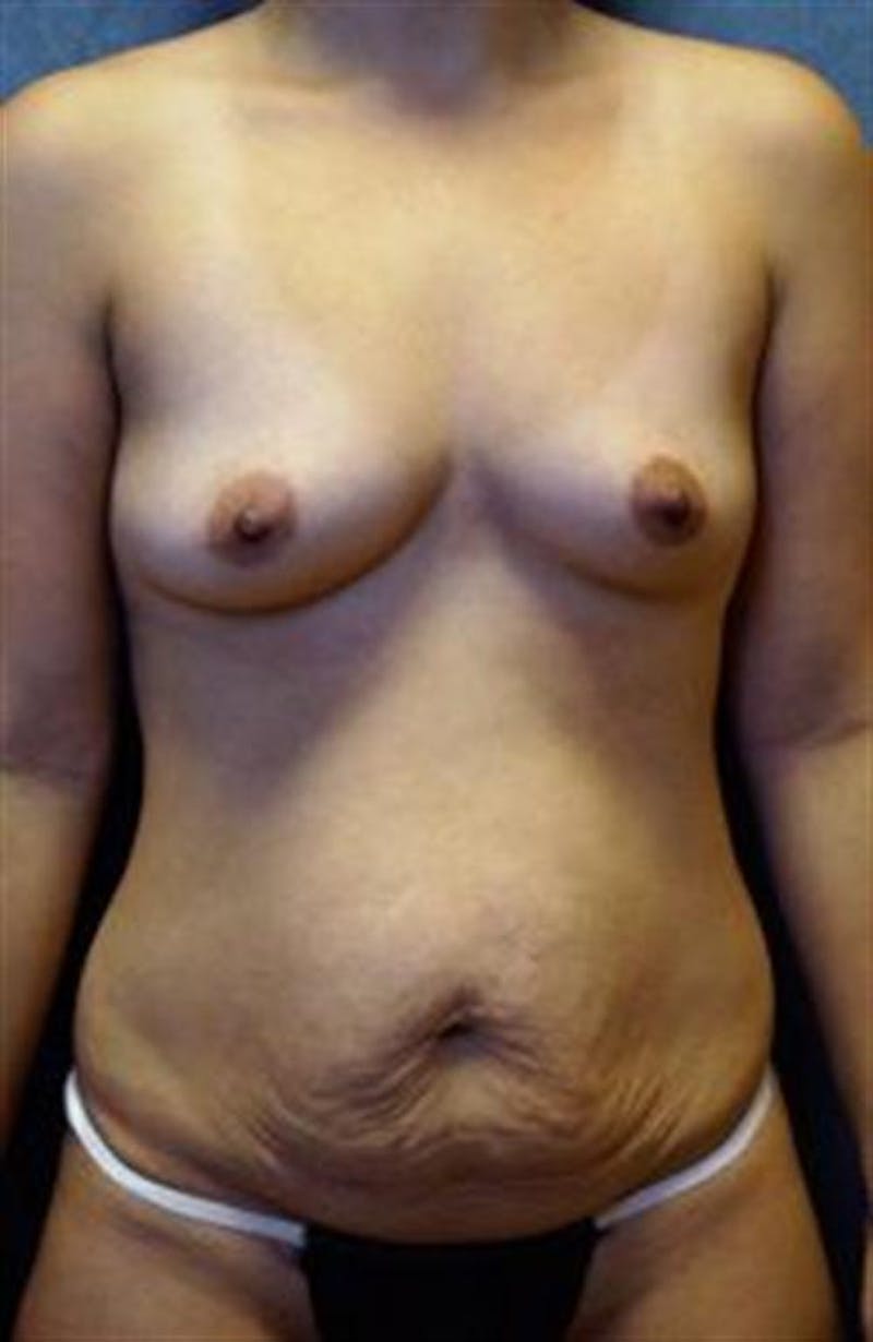 Mommy Makeover Body Contouring Before & After Gallery - Patient 798789 - Image 1