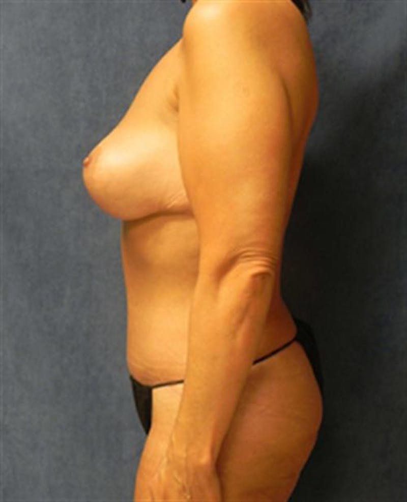 Mommy Makeover Body Contouring Before & After Gallery - Patient 420219 - Image 4
