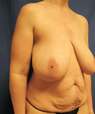 Mommy Makeover Body Contouring Before & After Gallery - Patient 210293 - Image 1