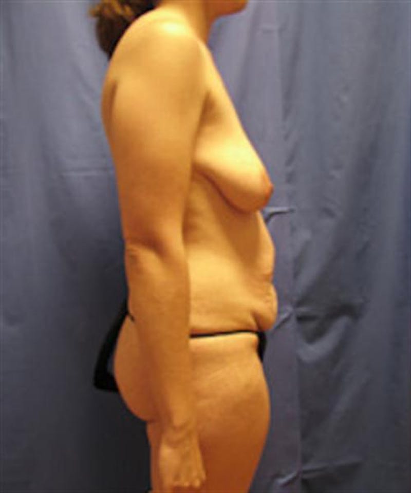 Mommy Makeover Body Contouring Before & After Gallery - Patient 304169 - Image 3