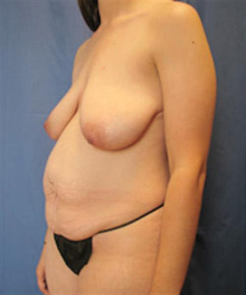 Mommy Makeover Body Contouring Before & After Gallery - Patient 304169 - Image 5
