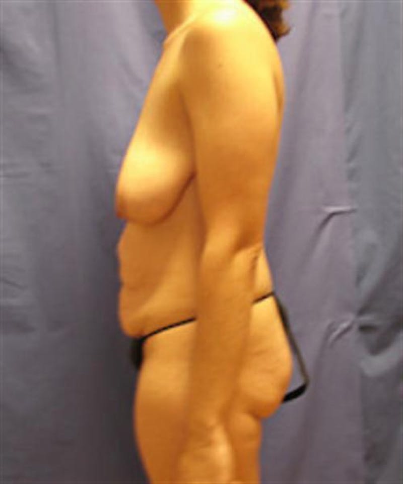Mommy Makeover Body Contouring Before & After Gallery - Patient 304169 - Image 7