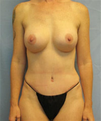 Mommy Makeover Body Contouring Before & After Gallery - Patient 415687 - Image 2