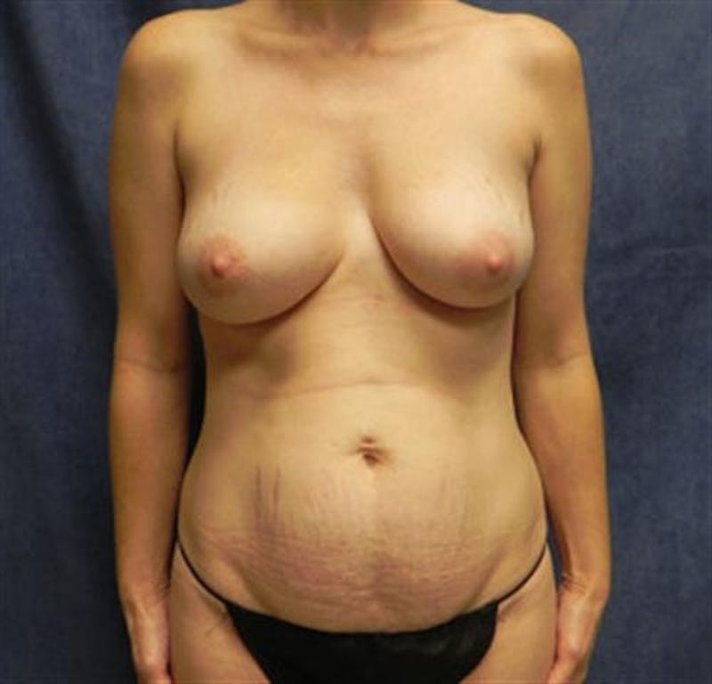 Mommy Makeover Body Contouring Before & After Gallery - Patient 423704 - Image 1