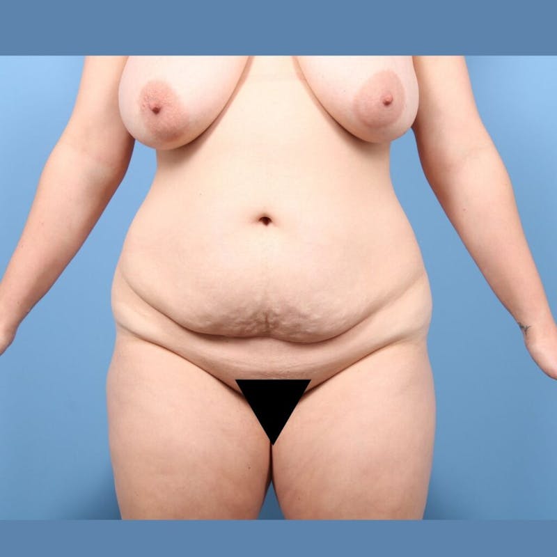Plus Size Mommy Makeover Before & After Gallery - Patient 139129 - Image 1