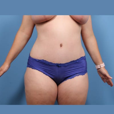 Plus Size Mommy Makeover Before & After Gallery - Patient 139129 - Image 2