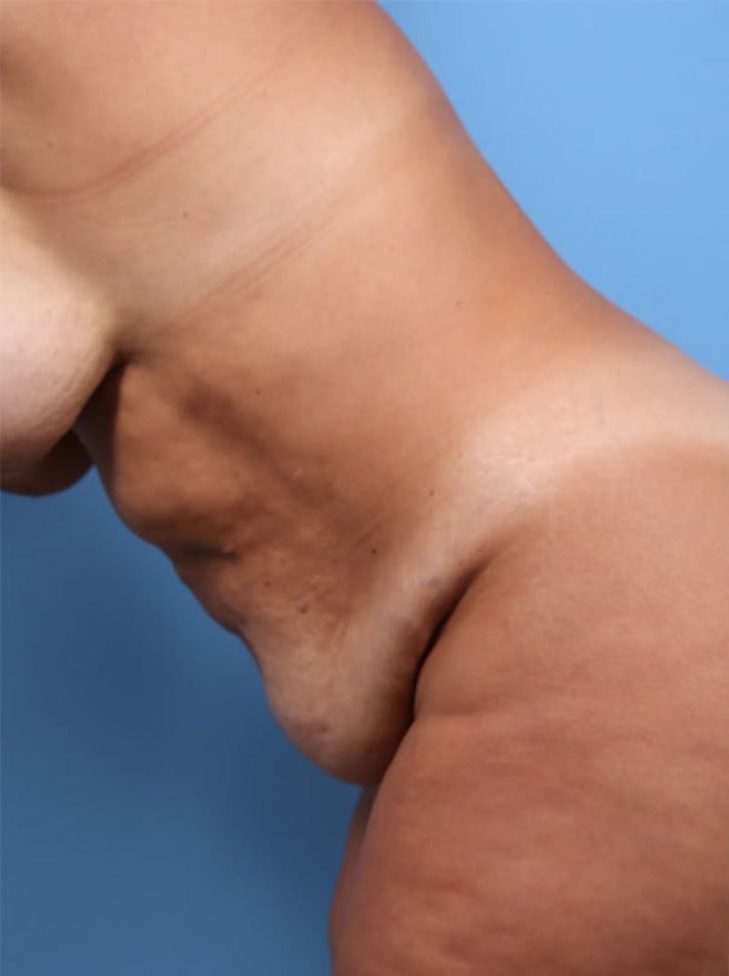 Plus Size Mommy Makeover Before & After Gallery - Patient 270243 - Image 5