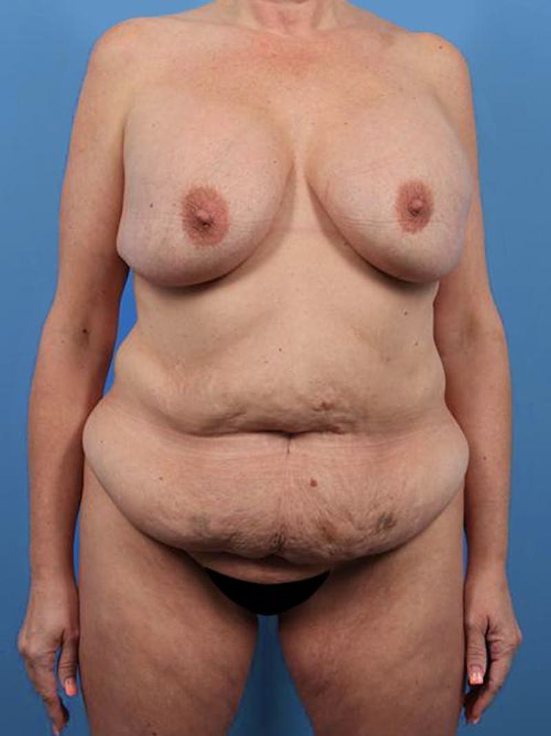 Plus Size Mommy Makeover Before & After Gallery - Patient 140669 - Image 1