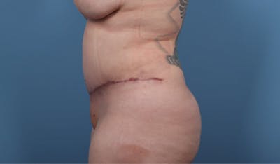 Plus Size Tummy Tuck Before & After Gallery - Patient 177796 - Image 2