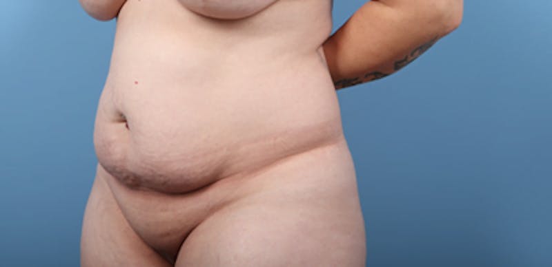 Plus Size Tummy Tuck Before & After Gallery - Patient 158337 - Image 1
