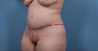 Plus Size Tummy Tuck Before & After Gallery - Patient 158337 - Image 2