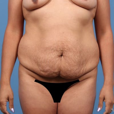 Plus Size Tummy Tuck Before & After Gallery - Patient 113442 - Image 1