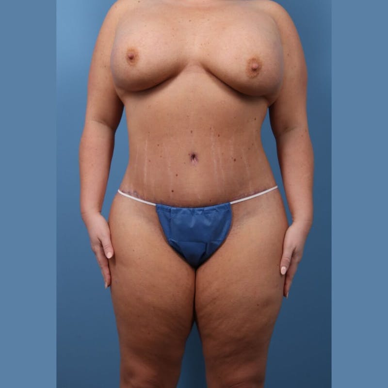 Plus Size Tummy Tuck Before & After Gallery - Patient 325651 - Image 2