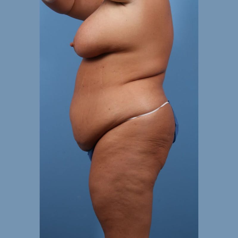 Plus Size Tummy Tuck Before & After Gallery - Patient 325651 - Image 3