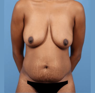 Tummy Tuck Before & After Gallery - Patient 316966 - Image 1