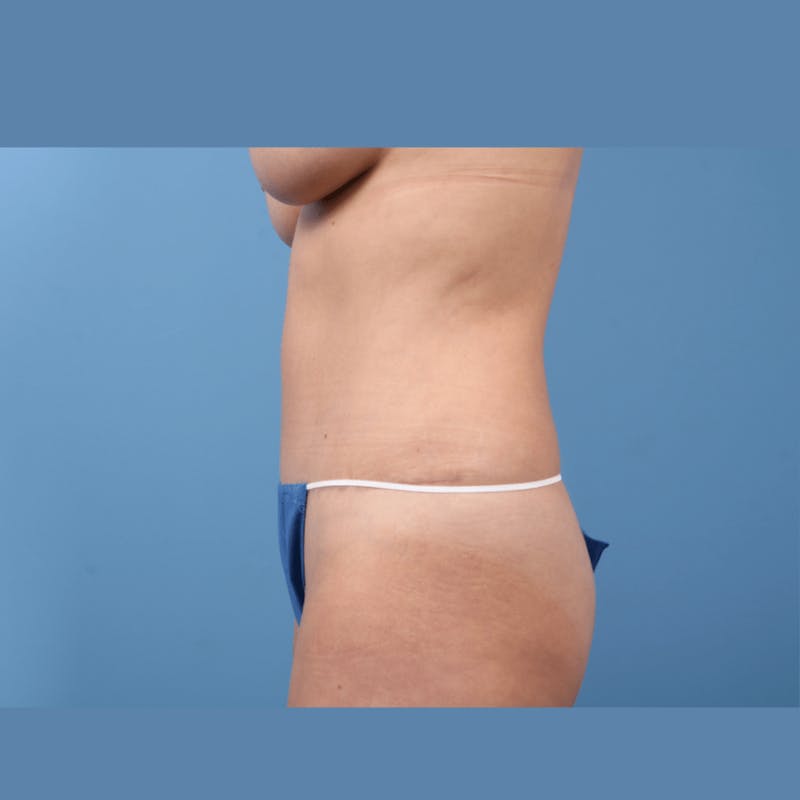 Tummy Tuck Before & After Gallery - Patient 276317 - Image 6
