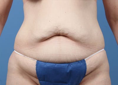 Tummy Tuck Before & After Gallery - Patient 189891 - Image 1