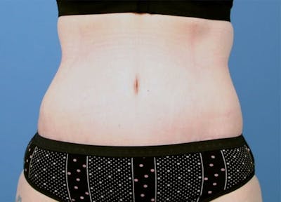 Tummy Tuck Before & After Gallery - Patient 189891 - Image 2