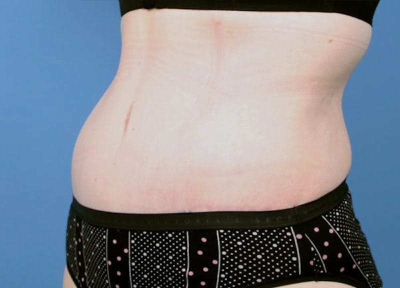 Tummy Tuck Before & After Gallery - Patient 189891 - Image 4