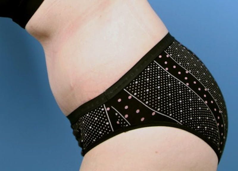 Tummy Tuck Before & After Gallery - Patient 189891 - Image 6