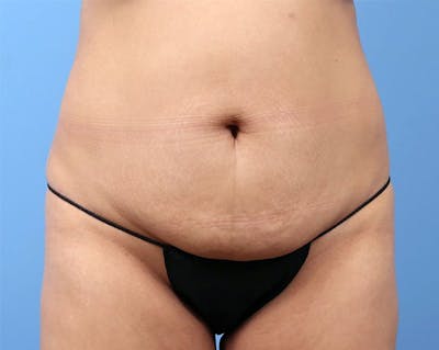 Tummy Tuck Before & After Gallery - Patient 142165 - Image 1