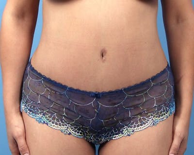 Tummy Tuck Before & After Gallery - Patient 142165 - Image 2