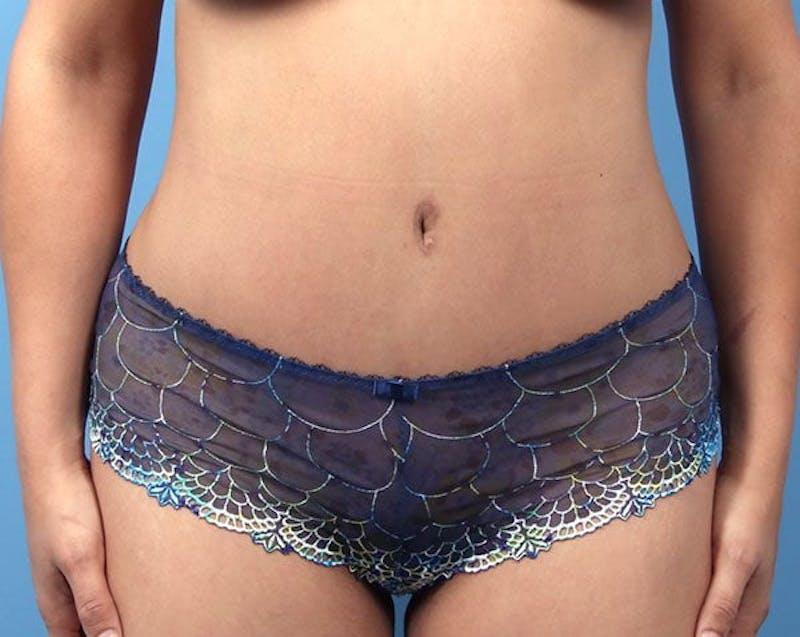 Tummy Tuck Before & After Gallery - Patient 142165 - Image 2
