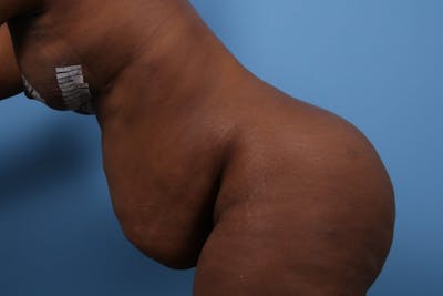 Tummy Tuck Before & After Gallery - Patient 201588 - Image 1