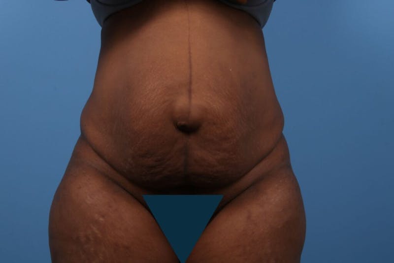 Tummy Tuck Before & After Gallery - Patient 201588 - Image 3