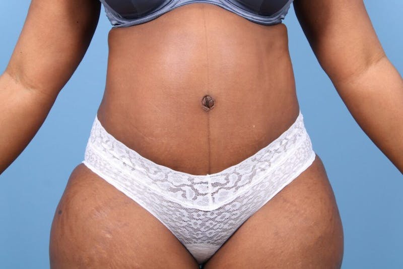 Tummy Tuck Before & After Gallery - Patient 201588 - Image 4