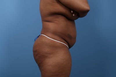 Tummy Tuck Before & After Gallery - Patient 112353 - Image 1
