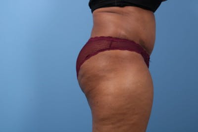 Tummy Tuck Before & After Gallery - Patient 112353 - Image 2