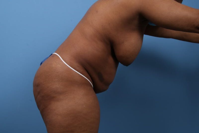Tummy Tuck Before & After Gallery - Patient 112353 - Image 3