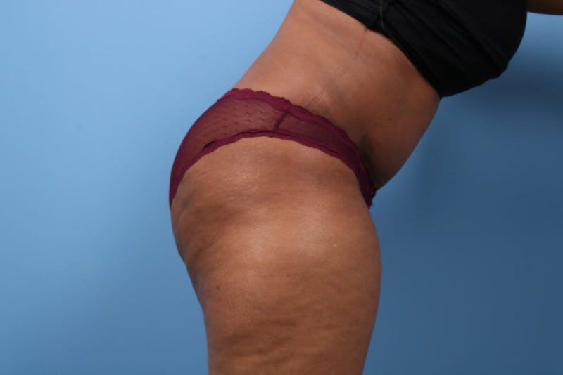 Tummy Tuck Before & After Gallery - Patient 112353 - Image 4