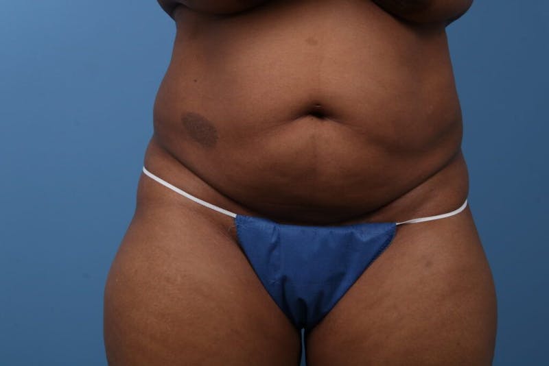 Tummy Tuck Before & After Gallery - Patient 112353 - Image 5