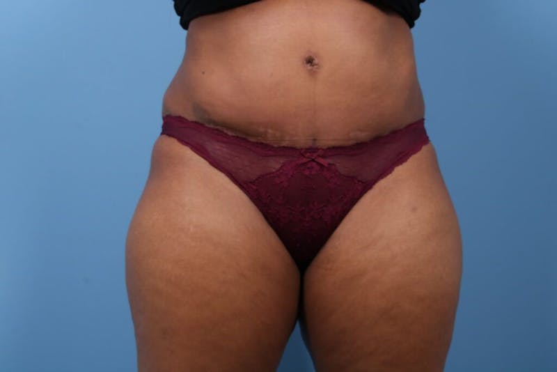 Tummy Tuck Before & After Gallery - Patient 112353 - Image 6