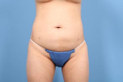 Tummy Tuck Before & After Gallery - Patient 324112 - Image 1