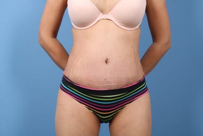 Tummy Tuck Before & After Gallery - Patient 324112 - Image 2